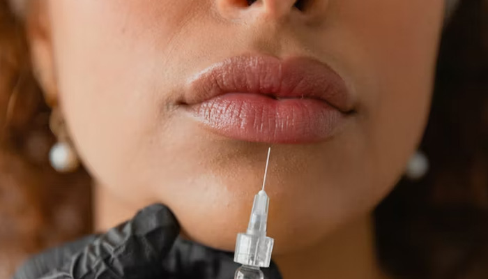 فیلر لب روسی